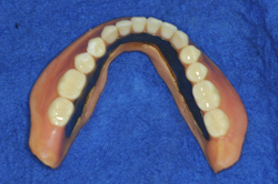 完成義歯下顎チタン床
