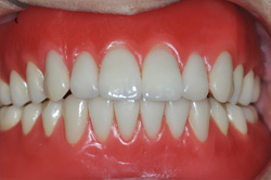 快適機能義歯（試作段階の入れ歯）