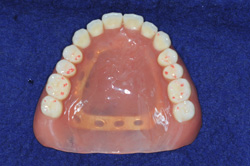 完成義歯上顎 チタン立体構造埋込