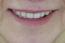 自然な入れ歯の顔だち（完成後）4