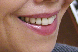 自然な入れ歯の顔だち（完成後）5