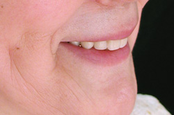 自然な入れ歯の顔だち（完成後）6