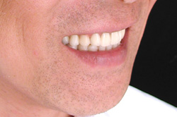 自然な入れ歯の顔だち（完成後）7