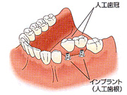 インプラント