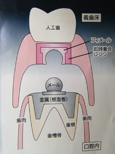 総入れ歯